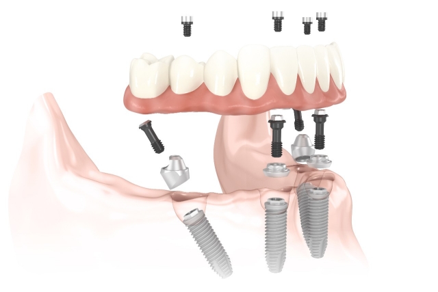 Dental Implants - Kyle, TX