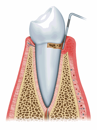 gum