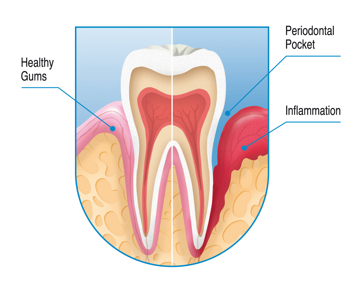 Root Canal Treatment - Kyle, TX - Toothache Relief