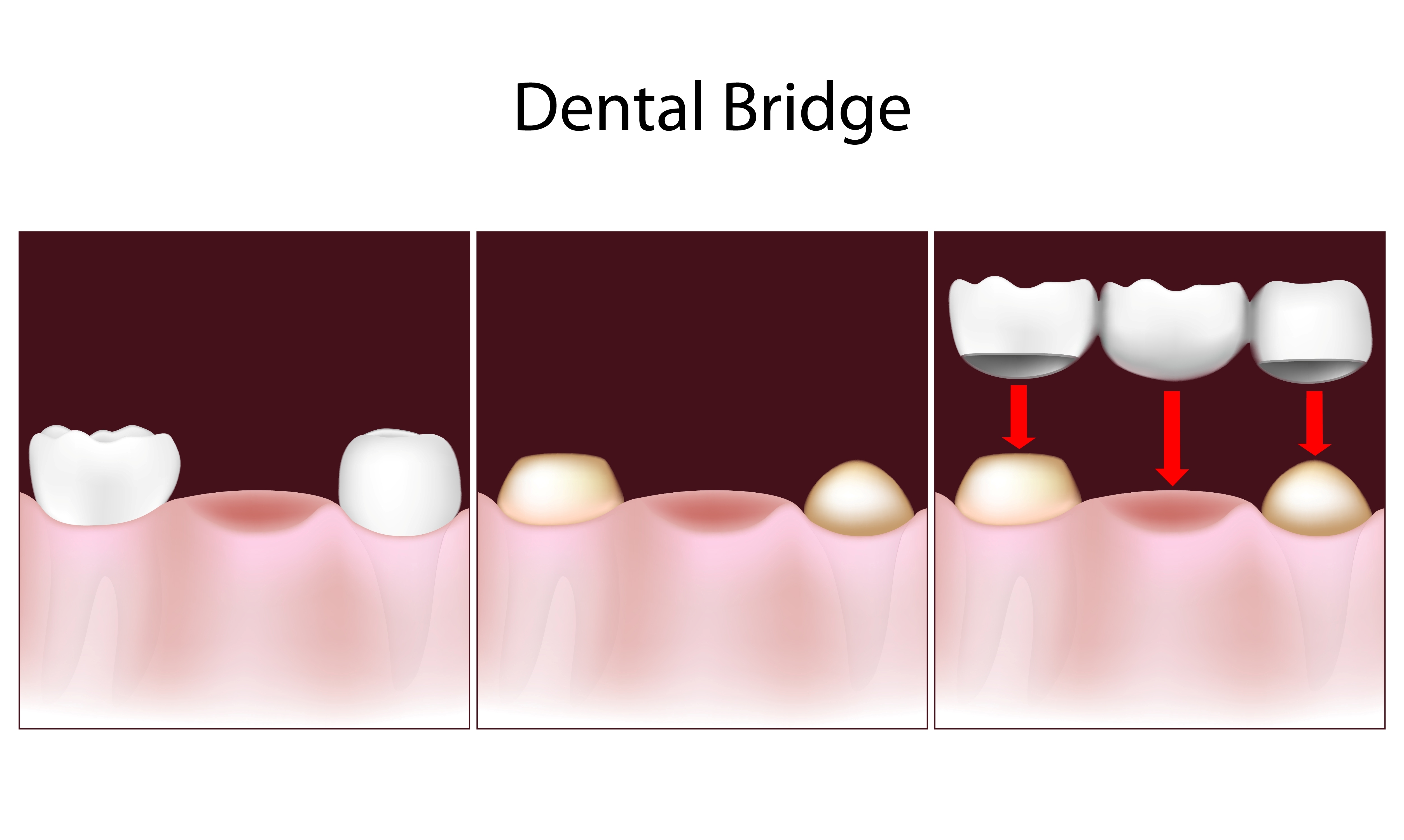 Dental Bridge - Kyle, TX