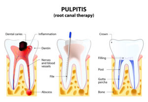 Root Canal Treatment - Kyle, TX - Toothache Relief