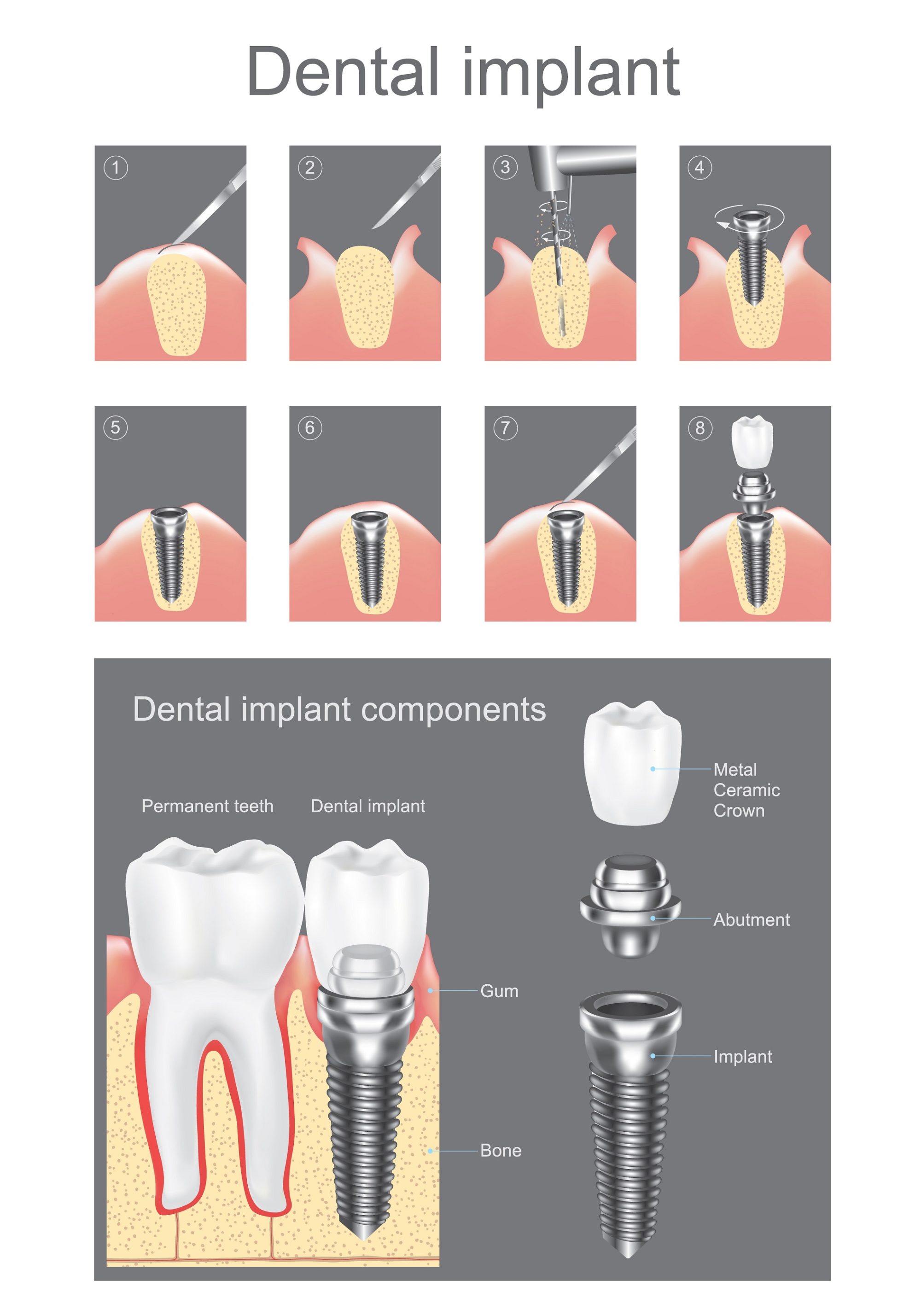 Dental Implants Kyle, TX & Buda, TX Restore Your Smile