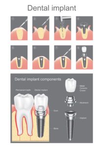 Dental Implants - Kyle, TX