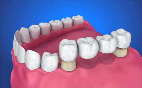 Dental Bridge