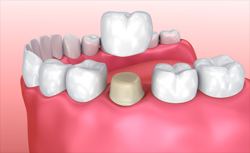 Dental Crown Example