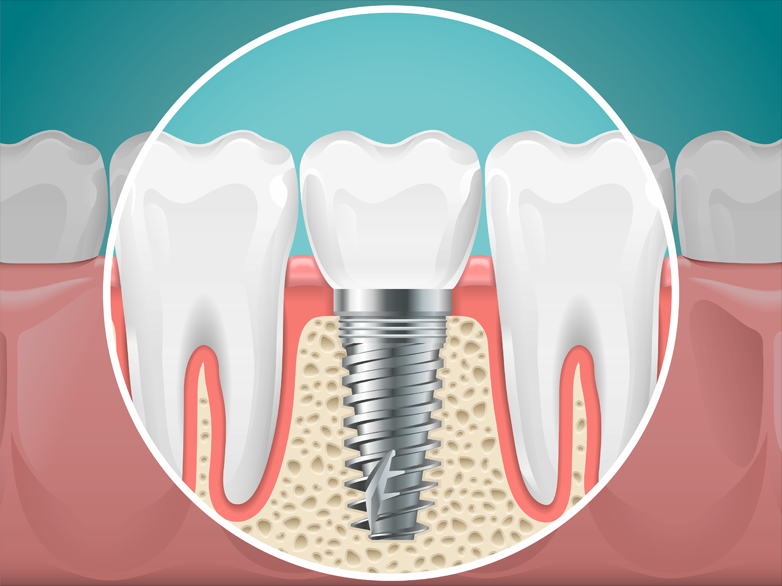 Dental-implant-graphic
