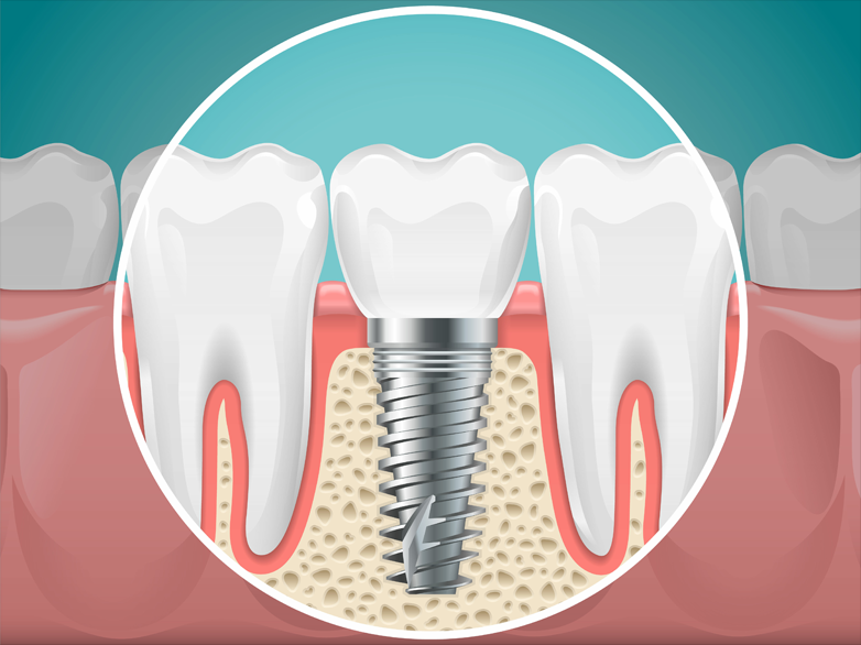 implant-graphic Dental-implant-graphic