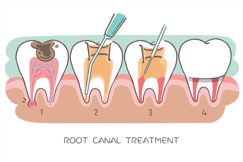 Root canal example